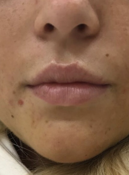 Dermal Fillers